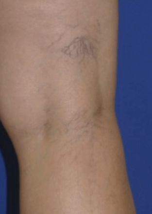 vericose veins